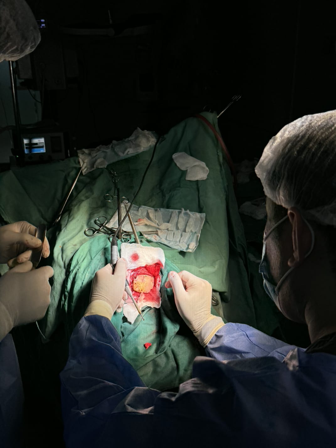 AEOS sistemi Azərbaycana ilk dəfə Medsol MMC tərəfindən gətirildi və Respublika Neyrocərrahiyyə Xəstəxanasında istifadəyə verildi. Yeni qurğu sayəsində artıq ilk əməliyyat uğurla həyata keçirildi. image 17